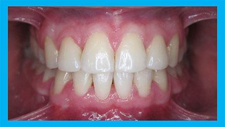 Patient #5 After